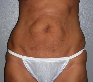 before Tummy Tuck female patient front view case 3377