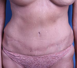 after Tummy Tuck female patient front view case 3377