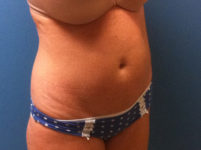 before Tummy Tuck female patient angle view case 3380