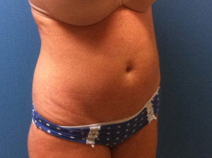before Tummy Tuck female patient angle view case 3380
