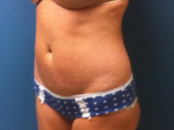 before Tummy Tuck female patient angle view case 3380