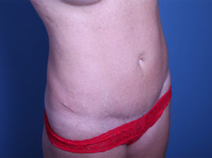 after Tummy Tuck female patient right angle view case 3380