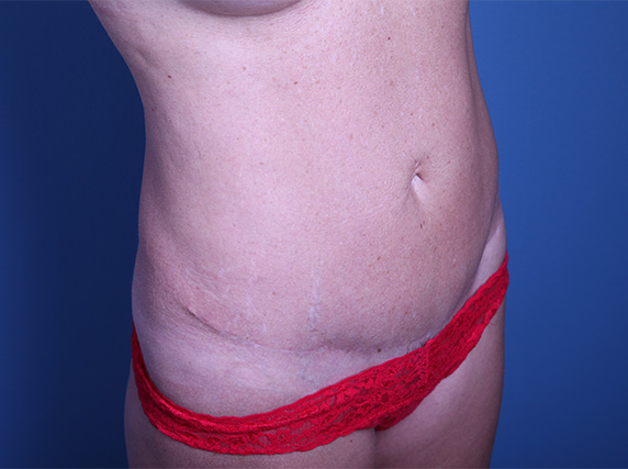 after Tummy Tuck female patient right angle view case 3380