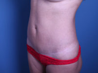 after Tummy Tuck female patient angle view case 3380