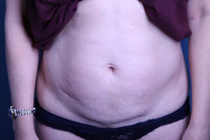 before Tummy Tuck female patient front view case 3385