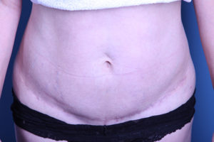 after Tummy Tuck female patient front view case 3385