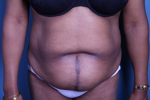 before Tummy Tuck female patient front view case 3388