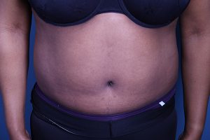 after Tummy Tuck front view case 3388
