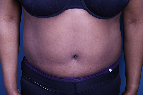 after Tummy Tuck front view case 3388