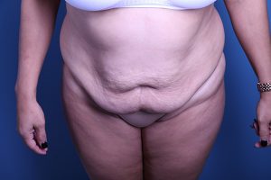 before Tummy Tuck front view case 3391