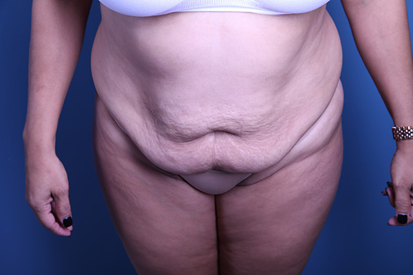 before Tummy Tuck front view case 3391