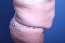before Tummy Tuck side view case 3391