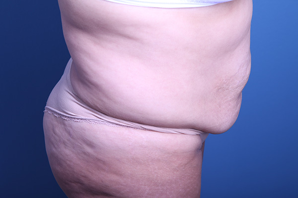 before Tummy Tuck side view case 3391
