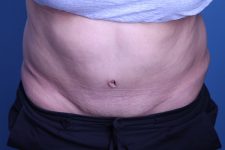 after Tummy Tuck female patient front view case 3391