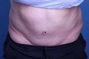 after Tummy Tuck female patient front view case 3391