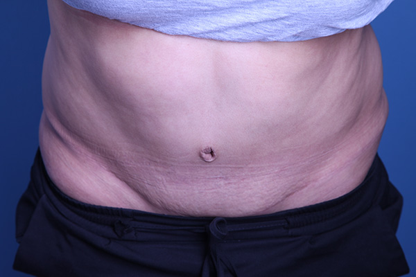 after Tummy Tuck female patient front view case 3391