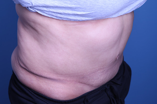 after Tummy Tuck male patient angle view case 3391