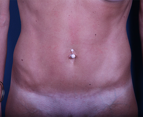 after Tummy Tuck female patient front view case 3396