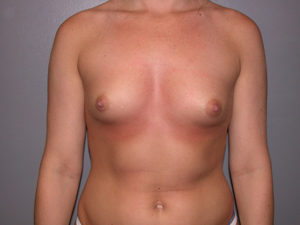 before Breast Augmentation front view case 3430
