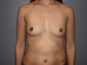 before breast augmentation front view female patient case 3450