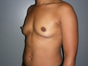before Breast Augmentation angle view female patient case 3458