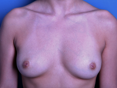 before breast augmentation front view female patient case 3519