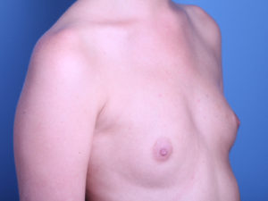 before breast augmentation right angle view female patient case 3532