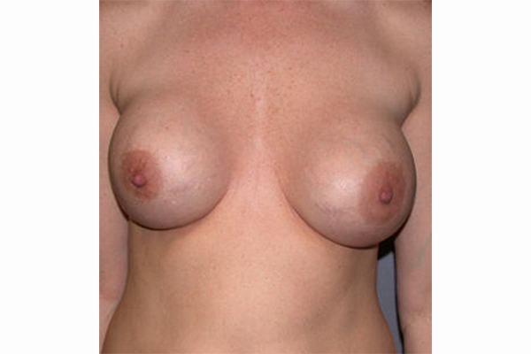 before breast augmentation with lift front view female patient case 3344