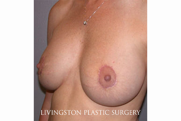 after breast augmentation with lift left angle view female patient case 3344