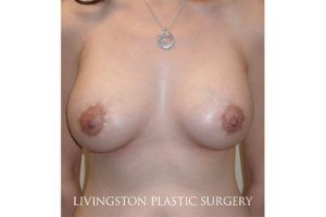 after breast augmentation with lift front view female patient case 3329