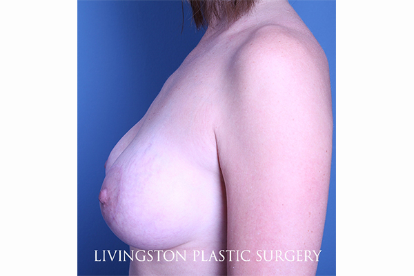 after breast augmentation with lift left side view female patient case 3336