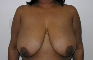 before breast reduction front view female patient case 3703