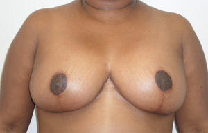 after breast reduction front view female patient case 3703