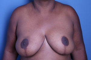 after breast reduction front view female patient case 3715