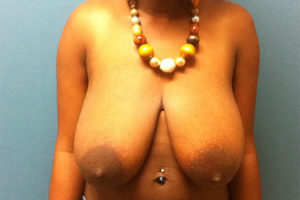 before breast reduction front view female patient case 3731