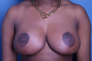 after breast reduction front view female patient case 3731