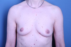 before breast reconstruction front view female patient case 3284