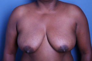 before breast reconstruction front view female patient case 3297