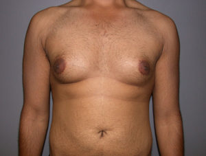 before gynecomastia surgery front view of male patient 3583