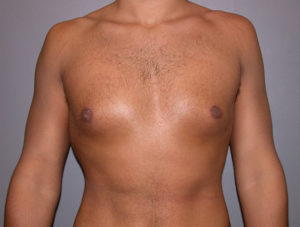 after gynecomastia surgery front view of male patient 3583