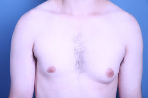 before gynecomastia surgery front view of male patient 3586