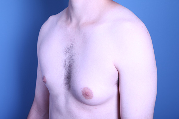 before gynecomastia surgery left angle view of male patient 3586