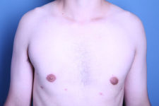 after gynecomastia surgery front view of male patient 3586