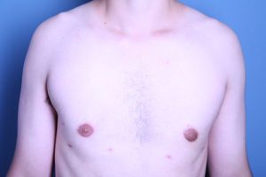 after gynecomastia surgery front view of male patient 3586