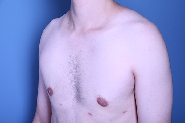 after gynecomastia surgery left angle view of male patient 3586