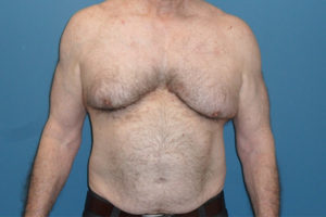 before gynecomastia surgery front view of male patient 3591
