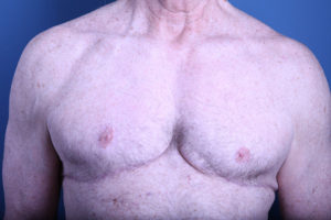after gynecomastia surgery front view of male patient 3591