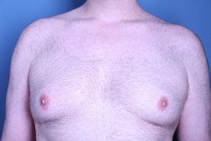 before gynecomastia surgery front view of male patient 3594
