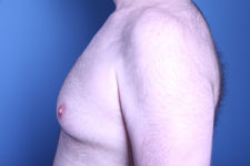 before gynecomastia surgery left side view of male patient 3594