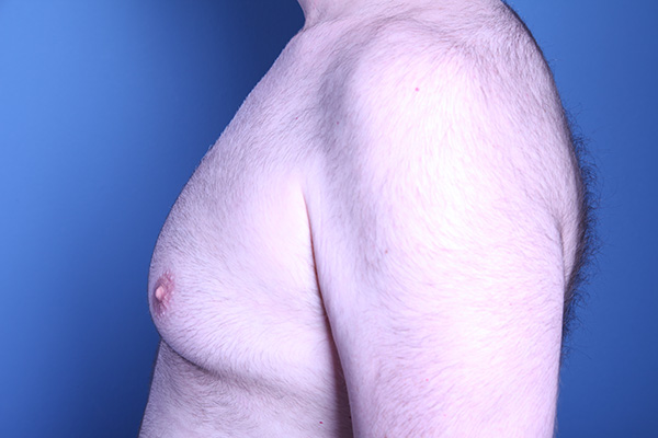 before gynecomastia surgery left side view of male patient 3594